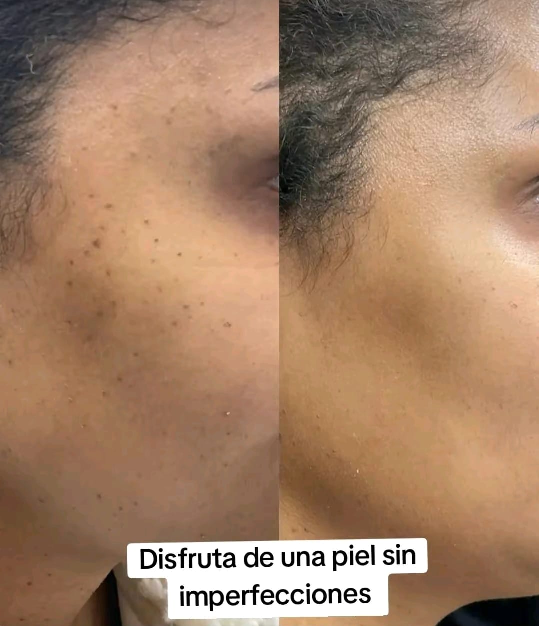 🌿 Eliminador de Verrugas