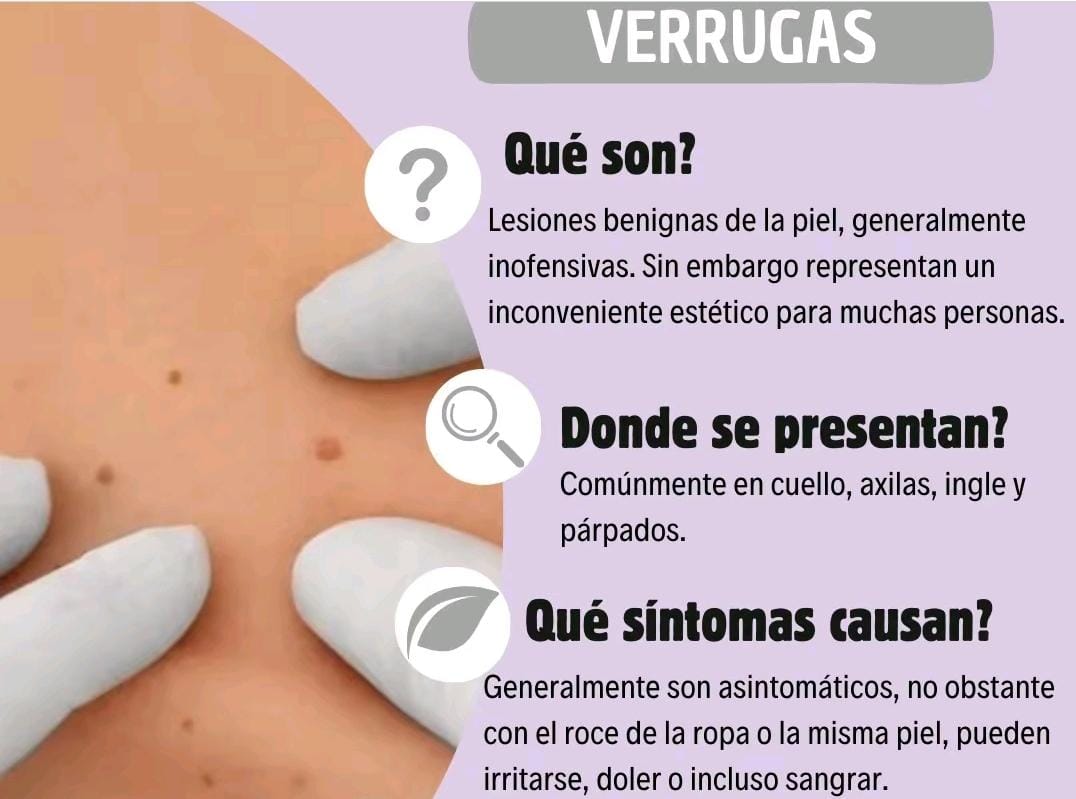 🌿 Eliminador de Verrugas