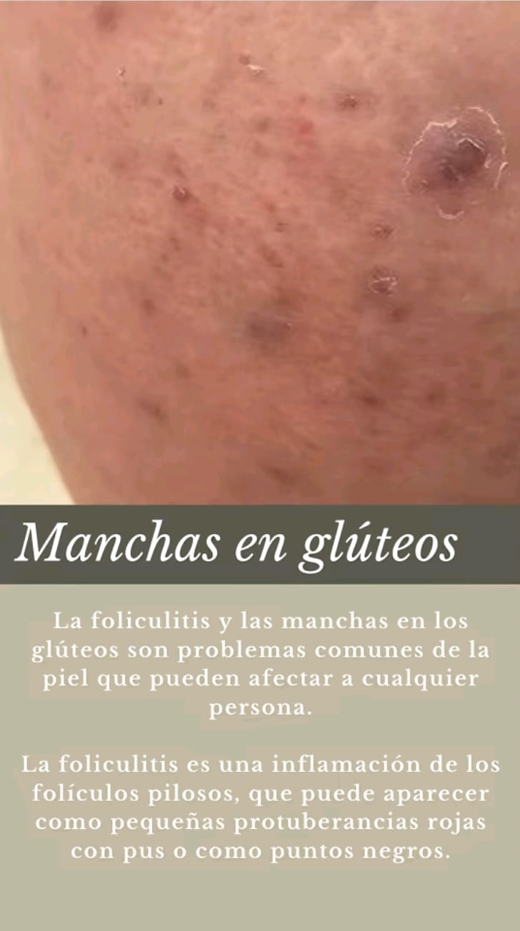 The Ordinary Ácido Glicólico💧